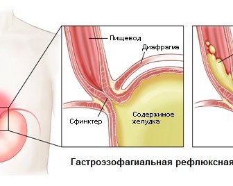 Гастроэзофагеальная рефлюксная болезнь (ГЭРБ)