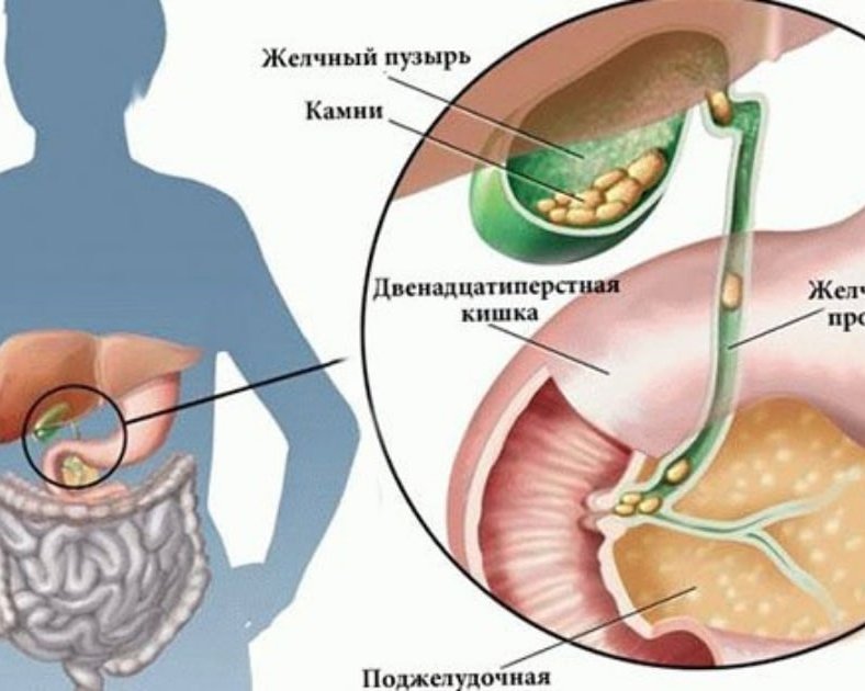 Камни в желчном пузыре.</p>
<p>Удалять или растворять?