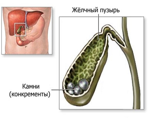 Желчнокаменная болезнь