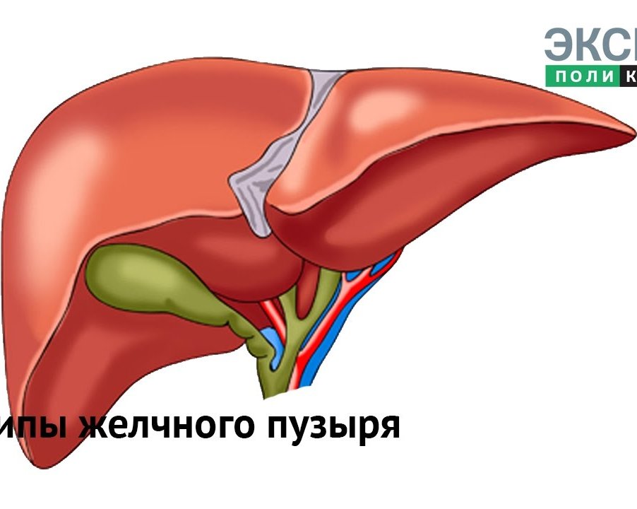 Полипы желчного пузыря