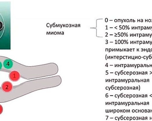 Полипы и миомы матки.</p>
<p>Диагностика и лечение