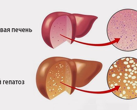 Неалкогольная жировая болезнь печени (НАЖБП)