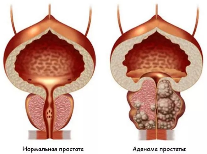 Аденома простаты