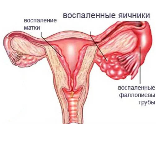 Аднексит (воспаление придатков)