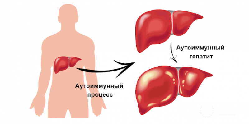 Аутоиммунный гепатит