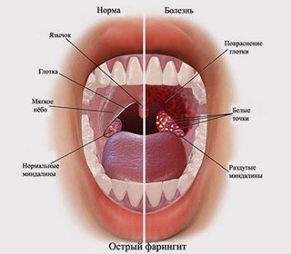 Острый и хронический фарингит