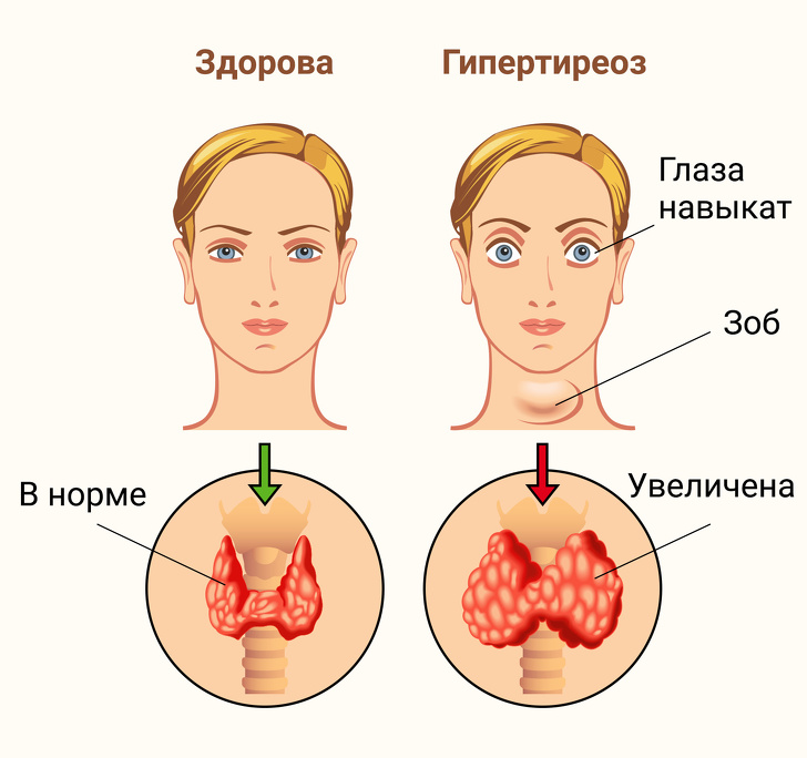 Заболевания щитовидной железы